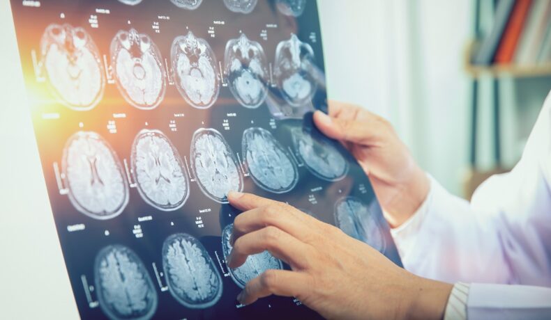 Doctor care studiază radiografia unui creier. Mini-creierele crescute în laborator au studiat timp de zeci de zile